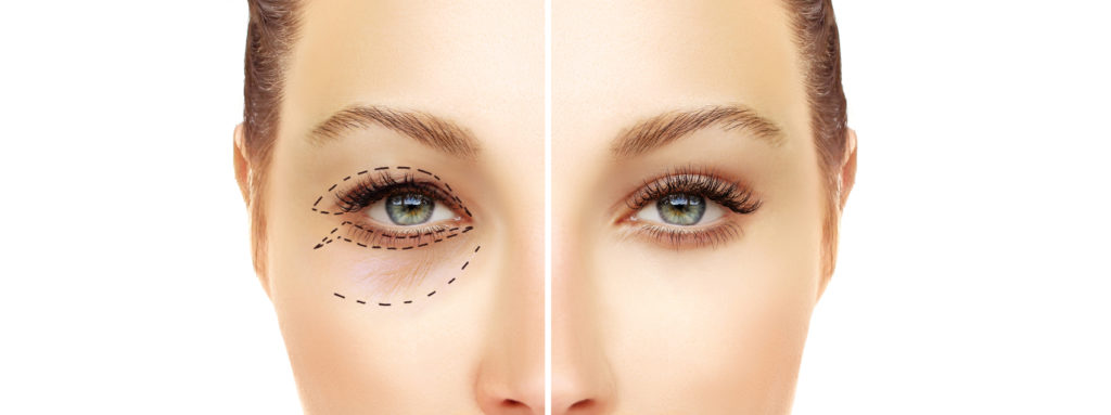 blepharoplasty